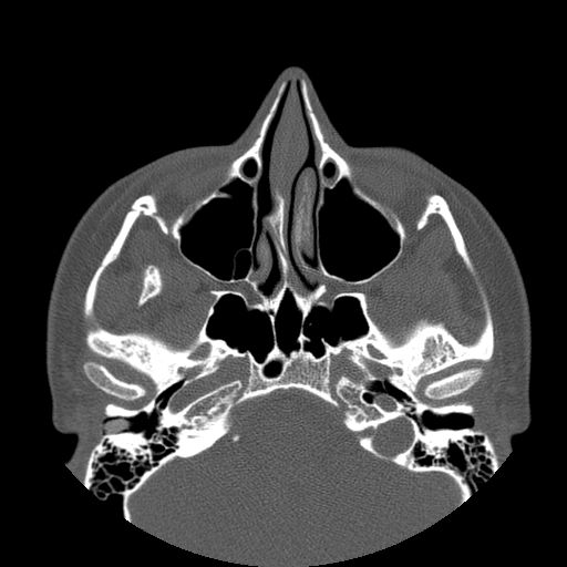 Aneurysmal bone cyst of the mandible (Radiopaedia 43280-46823 Axial bone window 144).jpg