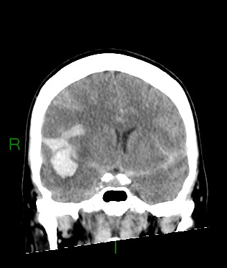 Aneurysmal subarachnoid hemorrhage with intra-axial extension (Radiopaedia 84371-99699 Coronal non-contrast 41).jpg