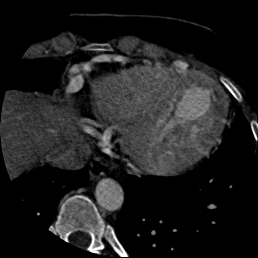 File:Anomalous left coronary artery from the pulmonary artery (ALCAPA) (Radiopaedia 40884-43586 A 71).jpg