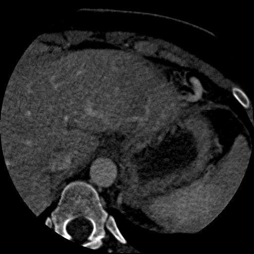 Anomalous left coronary artery from the pulmonary artery (ALCAPA) (Radiopaedia 40884-43586 A 90).jpg