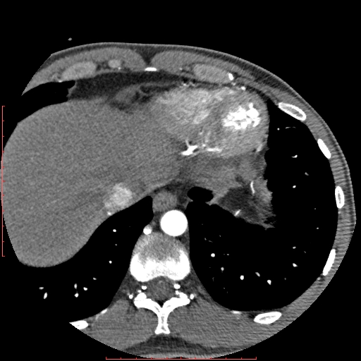 File:Anomalous left coronary artery from the pulmonary artery (ALCAPA) (Radiopaedia 70148-80181 A 353).jpg