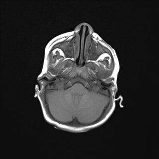 File:Anoxic brain injury (Radiopaedia 79165-92139 Axial T1 6).jpg