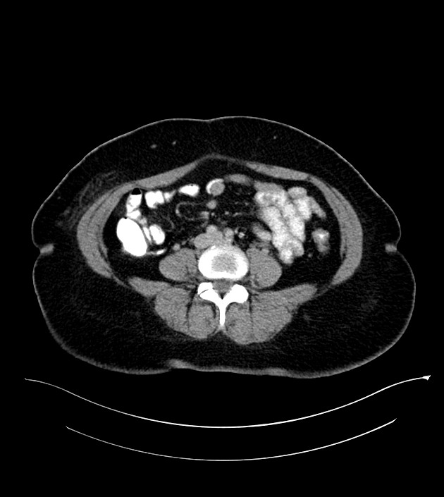 Anterior abdominal wall CSF pseudocyst (CSFoma) (Radiopaedia 79453-92571 A 58).jpg