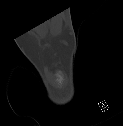 File:Anterior calcaneal process fracture (Radiopaedia 63353-71943 Axial bone window 123).jpg