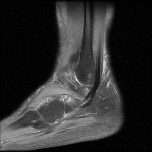 File:Anterior calcaneal process fracture (Radiopaedia 71377-81705 Sagittal PD fat sat 3).jpg