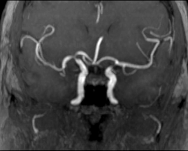 File:Anterior cerebral arterial variations (Radiopaedia 13132-13167 C 1).jpg