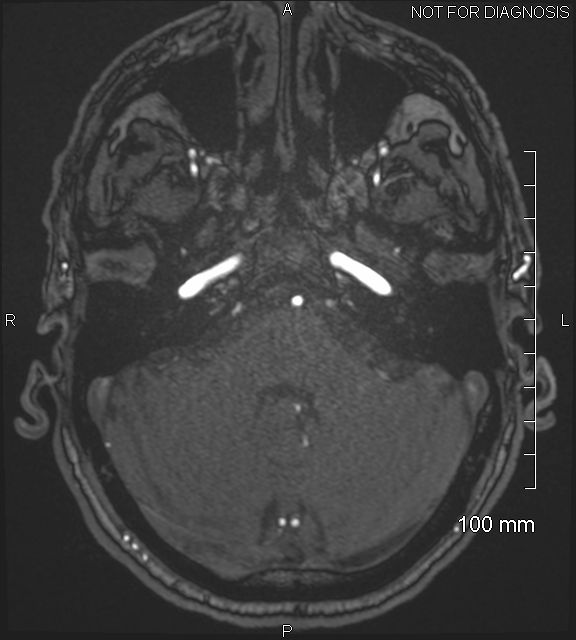 Anterior cerebral artery aneurysm (Radiopaedia 80683-94127 Axial MRA 50).jpg