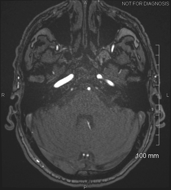 Anterior cerebral artery aneurysm (Radiopaedia 80683-94127 Axial MRA 53).jpg
