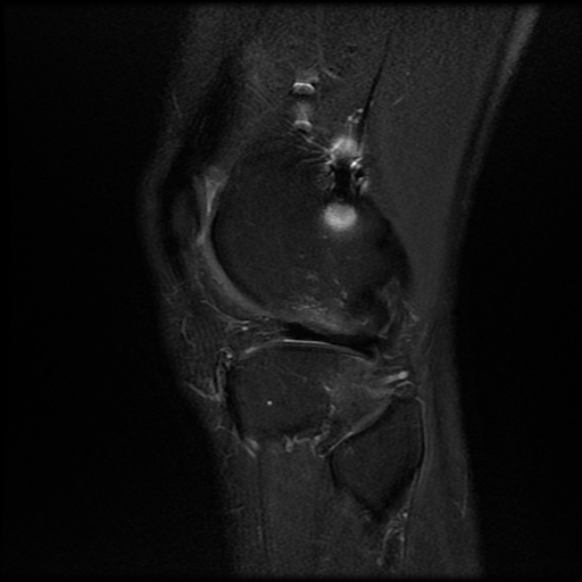 File:Anterior cruciate ligament graft tear and bucket-handle tear of medial meniscus (Radiopaedia 75867-87254 Sagittal PD fat sat 24).jpg