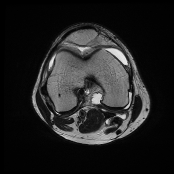 File:Anterior cruciate ligament graft tear and bucket-handle tear of medial meniscus (Radiopaedia 75867-87255 Axial T2 13).jpg