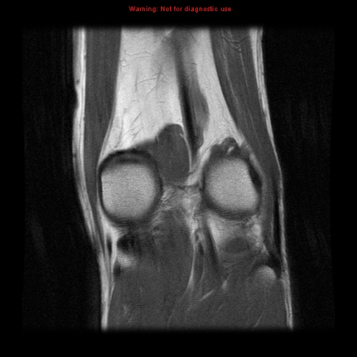 File:Anterior cruciate ligament injury - partial thickness tear (Radiopaedia 12176-12515 Coronal PD 16).jpg