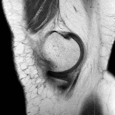 Anterior cruciate ligament mucoid degeneration (Radiopaedia 60853-68633 Sagittal T1 36).jpg