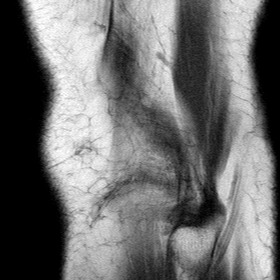 File:Anterior cruciate ligament mucoid degeneration (Radiopaedia 60853-68633 Sagittal T1 54).jpg