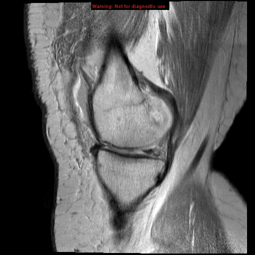 File:Anterior cruciate ligament tear (Radiopaedia 12329-12612 Sagittal T2 fat sat 15).jpg