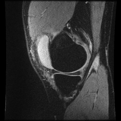 File:Anterior cruciate ligament tear (Radiopaedia 61500-69462 F 15).jpg
