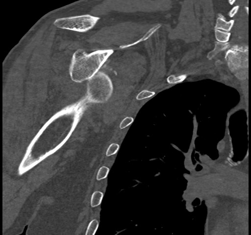 Anterior glenohumeral dislocation with Hill-Sachs lesion (Radiopaedia 62877-71249 Coronal bone window 59).jpg