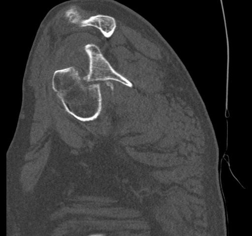Anterior glenohumeral dislocation with Hill-Sachs lesion (Radiopaedia 62877-71249 Sagittal bone window 30).jpg