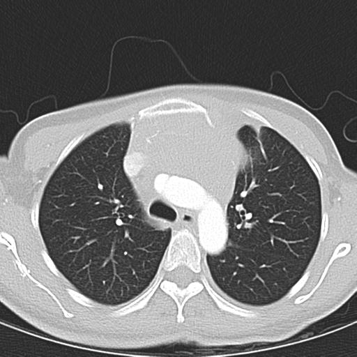 Anterior mediastinal lymphoma (Radiopaedia 29556-30061 Axial lung window 17).jpg