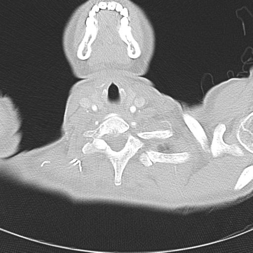 Anterior mediastinal lymphoma (Radiopaedia 29556-30061 Axial lung window 2).jpg
