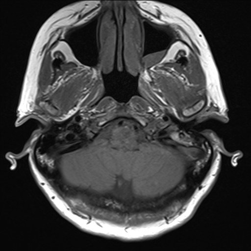 File:Anterior temporal encephalocele (Radiopaedia 82624-96808 Axial T1 4).jpg