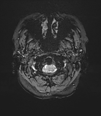 File:Anterior temporal lobe perivascular space (Radiopaedia 40946-43650 Axial SWI 2).png