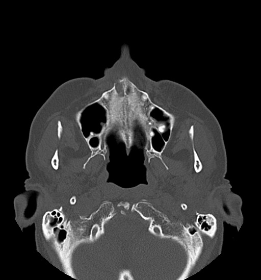 Anterior temporomandibular joint dislocation (Radiopaedia 59430-66784 Axial non-contrast 22).jpg