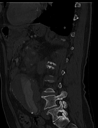 File:Anterior vertebral scalloping (abdominal aortic aneurysm) (Radiopaedia 66744-76067 Sagittal bone window 63).jpg
