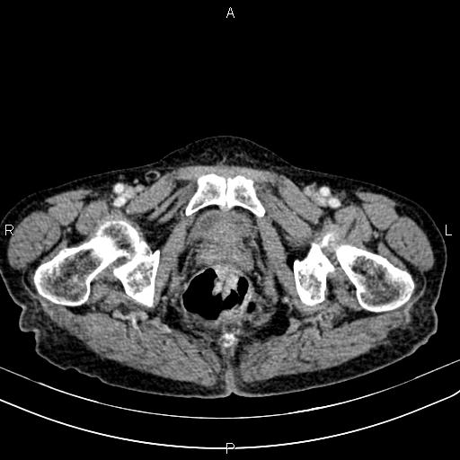 File:Aortic aneurysm and Lemmel syndrome (Radiopaedia 86499-102554 A 81).jpg