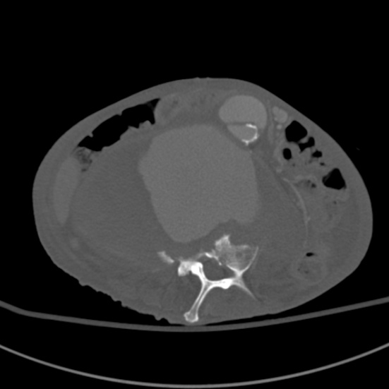 Aortic aneurysm with spinal destruction (Radiopaedia 42301-45410 Axial bone window 54).jpg