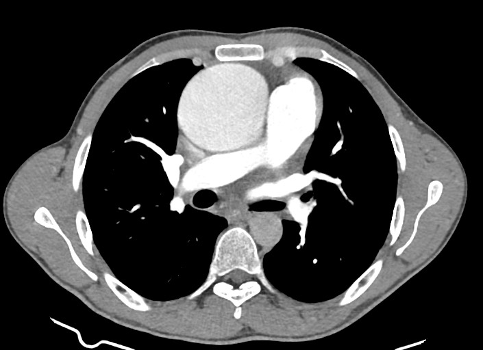 File:Aortic coarctation with aneurysm (Radiopaedia 74818-85828 A 120).jpg