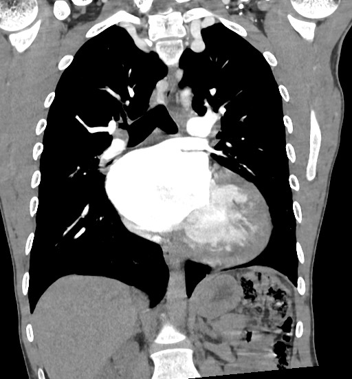 Aortic coarctation with aneurysm (Radiopaedia 74818-85828 C 66).jpg