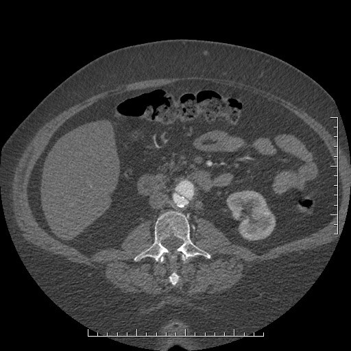 File:Aortic dissection- Stanford A (Radiopaedia 35729-37268 C 10).jpg