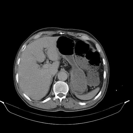 File:Aortic dissection- Stanford type A (Radiopaedia 22085-22085 Axial C+ delayed 12).jpg