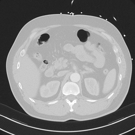 File:Aortic dissection (Radiopaedia 50763-56234 Axial lung window 69).png