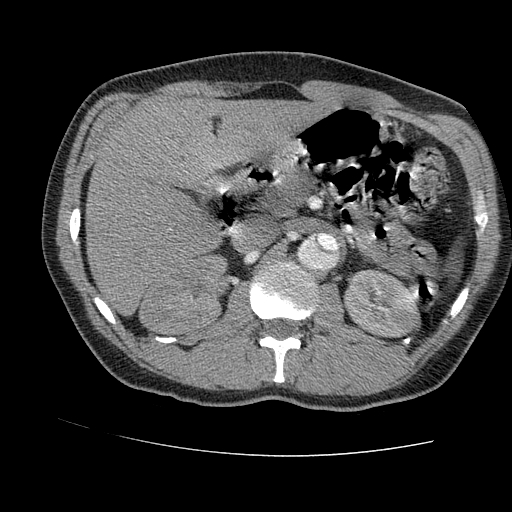 File:Aortic dissection - Stanford A -DeBakey I (Radiopaedia 28339-28587 B 122).jpg