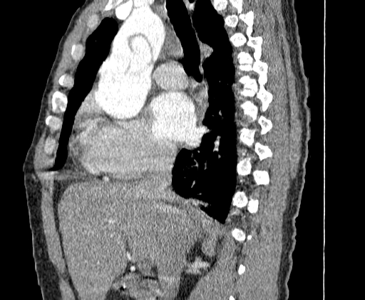 File:Aortic dissection - Stanford A -DeBakey I (Radiopaedia 28339-28587 C 11).jpg