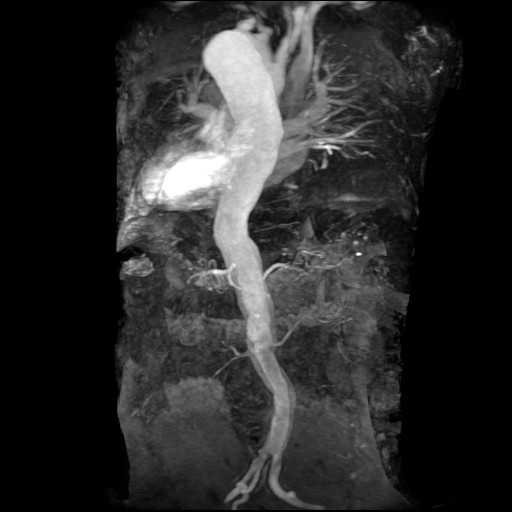 File:Aortic dissection - Stanford A - DeBakey I (Radiopaedia 23469-23551 MRA 14).jpg