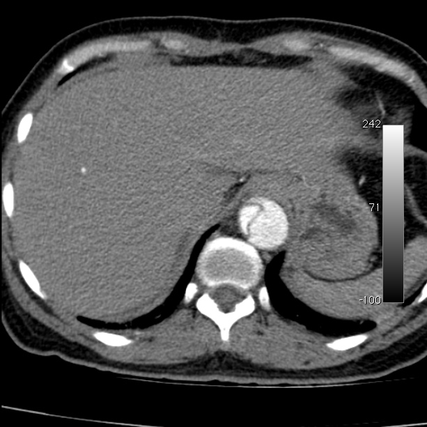 Aortic dissection - Stanford type A (Radiopaedia 29247-29659 A 67).jpg