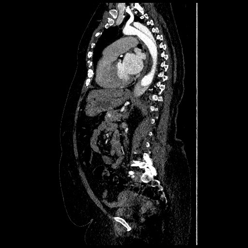 File:Aortic dissection - Stanford type B (Radiopaedia 88281-104910 C 48).jpg