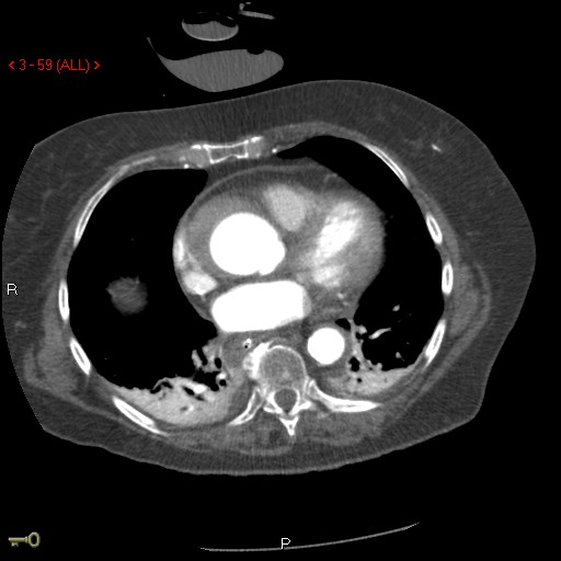 File:Aortic intramural hematoma (Radiopaedia 27746-28001 A 59).jpg