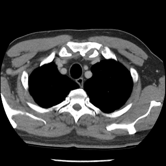 Aortic intramural hematoma (type B) (Radiopaedia 79323-92387 Axial C+ delayed 6).jpg