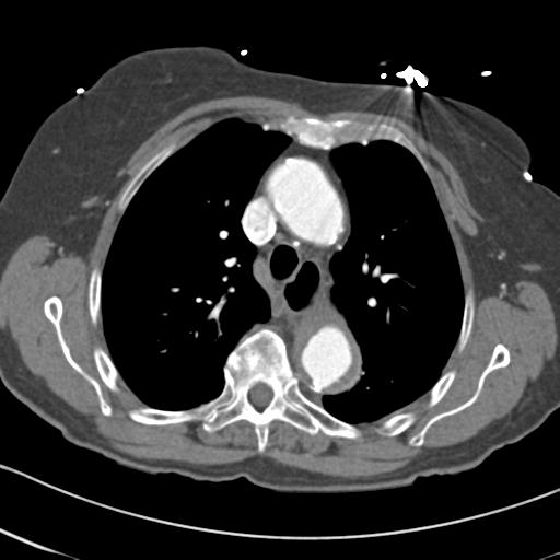 Aortic intramural hematoma from penetrating atherosclerotic ulcer (Radiopaedia 31137-31836 A 26).jpg
