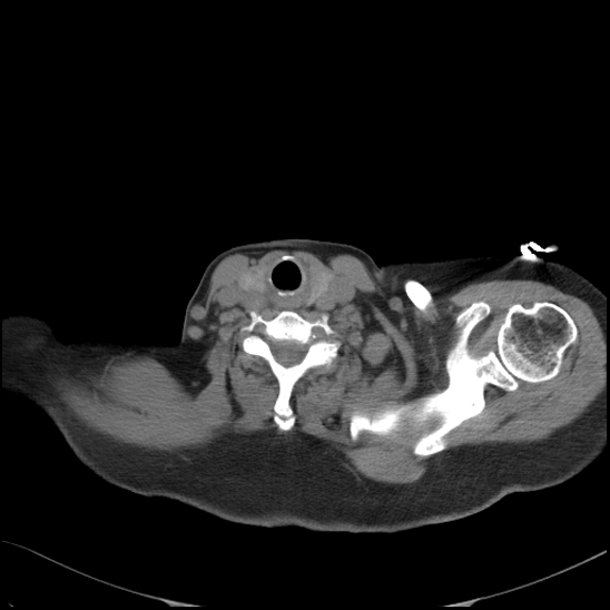 Aortic intramural hematoma with dissection and intramural blood pool (Radiopaedia 77373-89491 Axial non-contrast 5).jpg
