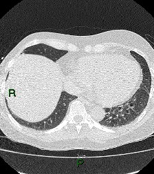 File:Aortic valve endocarditis (Radiopaedia 87209-103485 Axial lung window 75).jpg