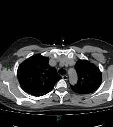 File:Aortic valve endocarditis (Radiopaedia 87209-103485 Axial non-contrast 26).jpg