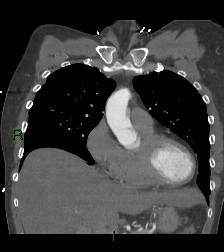 Aortic valve endocarditis (Radiopaedia 87209-103485 D 47).jpg