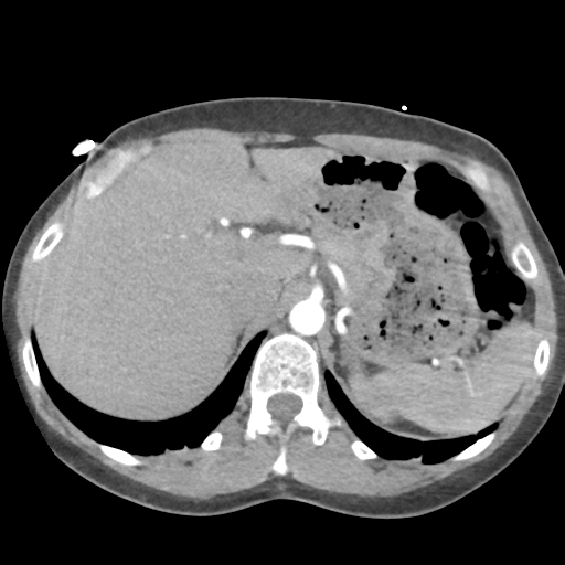 File:Aortic valve non-coronary cusp thrombus (Radiopaedia 55661-62189 B 50).png