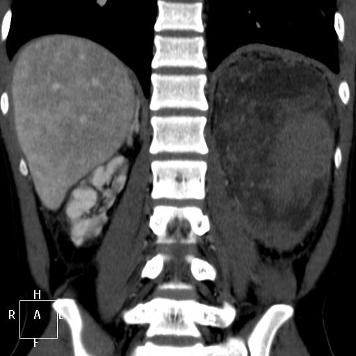 File:Aorto-left renal vein fistula (Radiopaedia 45534-49628 B 53).jpg