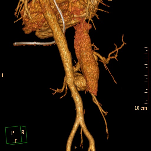 File:Aorto-left renal vein fistula (Radiopaedia 45534-49628 D 29).jpg