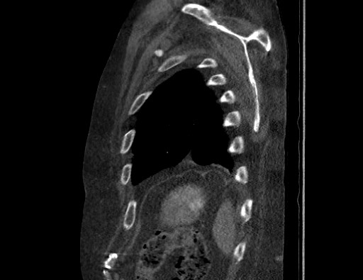 Aortoesophageal fistula with endovascular repair (Radiopaedia 73781-84592 Sagittal C+ CTPA 175).jpg